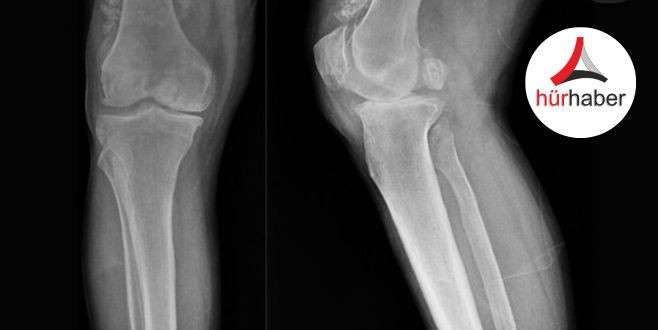 Başarılı Eklem Faresi Operasyonu